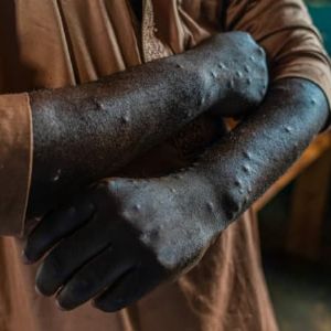 Première confirmation d'un cas du clade 1b de Mpox au Sierra Leone : patient isolé